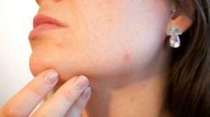 A száj körüli pattanások számos esetben a preiorális dermatitisz tünetei.