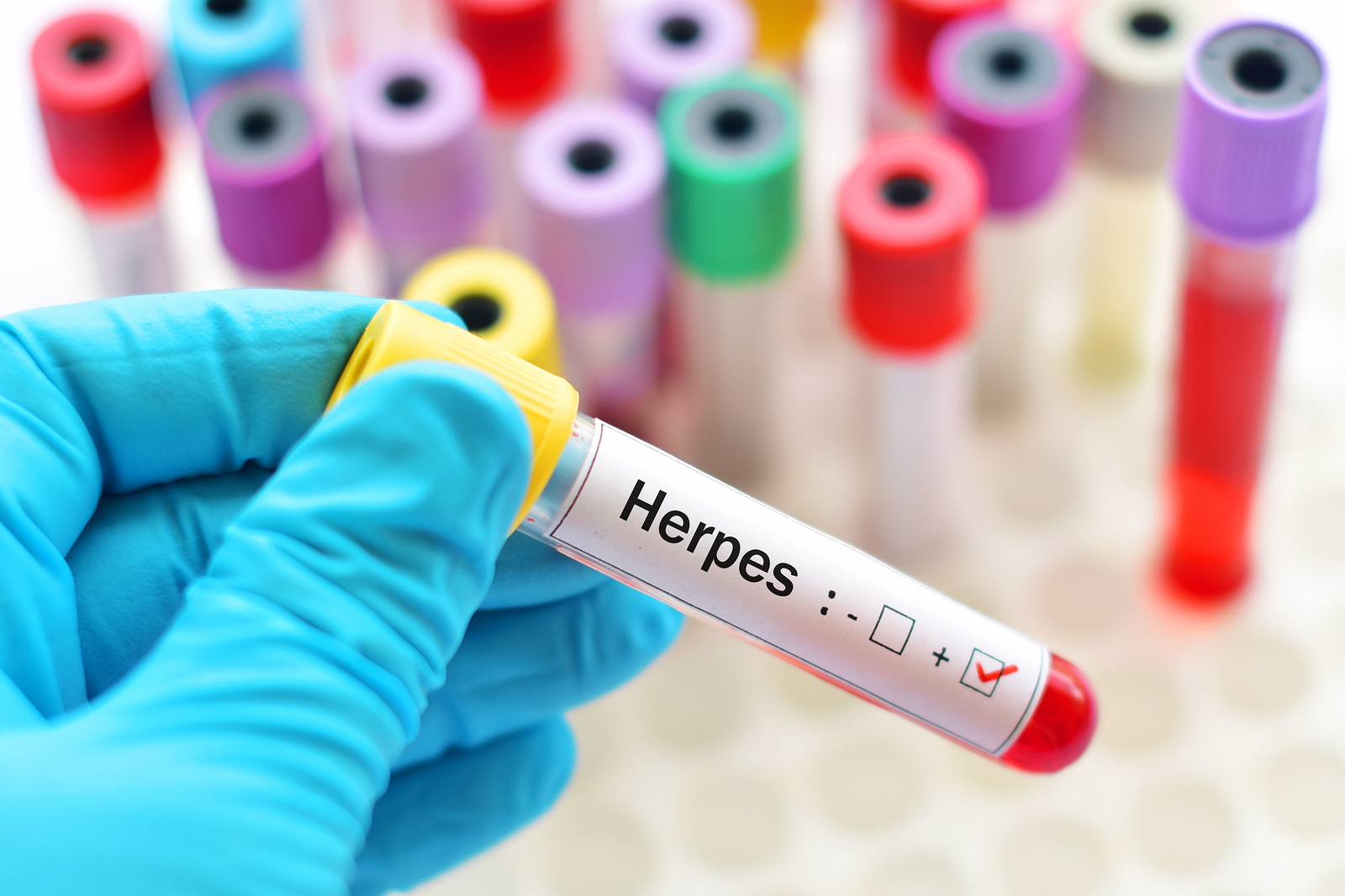 volt olyan kutatás, amelyik kapcsolatot állapított meg a kór és a herpex simplex vírus (HSV1) között