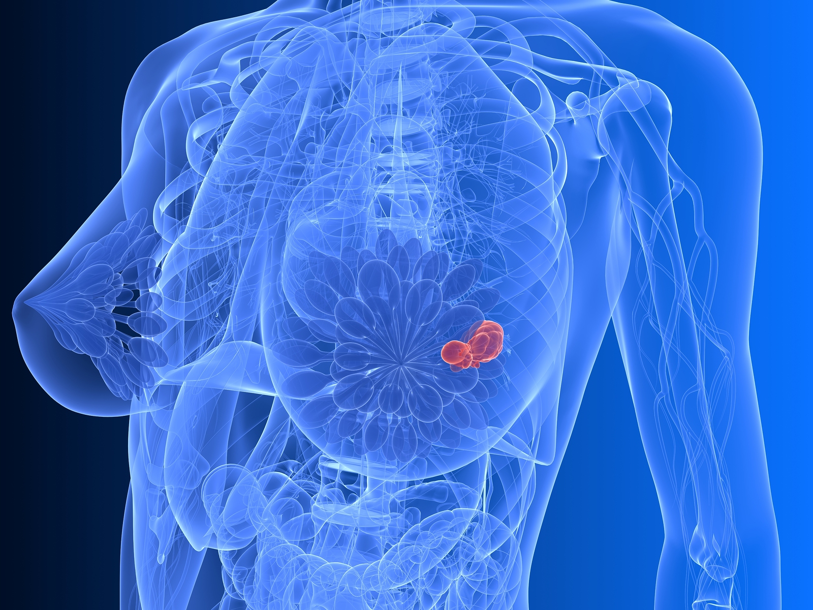 A mellrák tünete lehet a mell bőrének és a mellbimbó elváltozása is