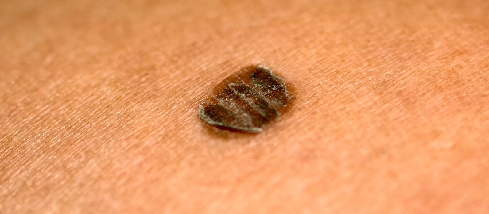 Акральная меланома кожи