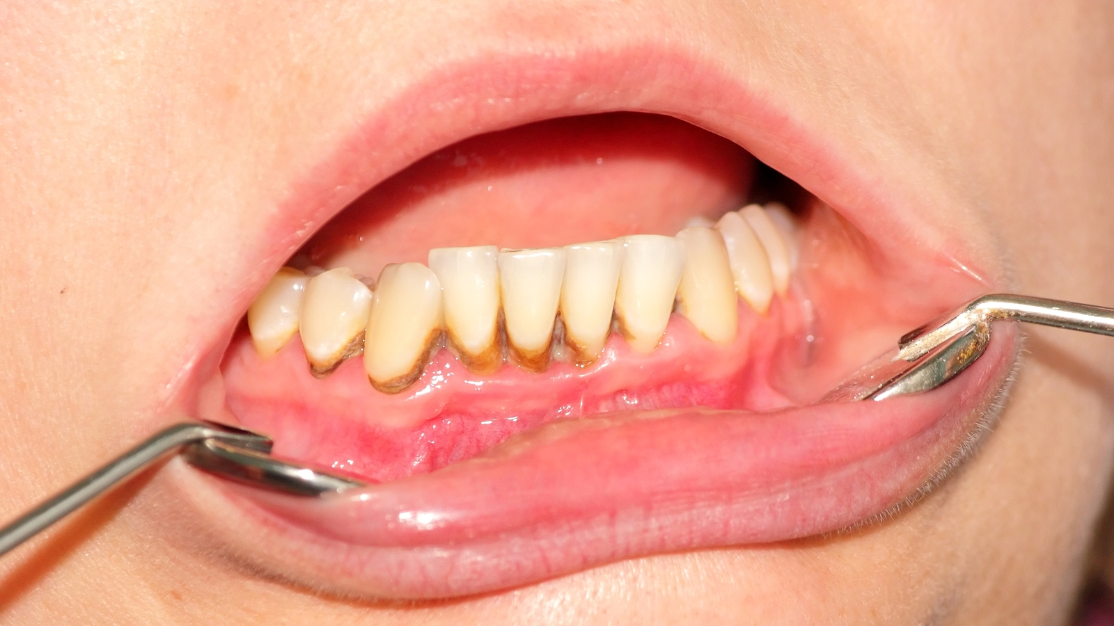 Parodontitis rossz lehelet - Hogyan lehet megszabadulni a férgektől tabletták nélkül