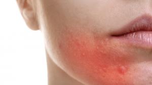 Bőrgyulladás ellen ǀ Milyen módszerek léteznek?